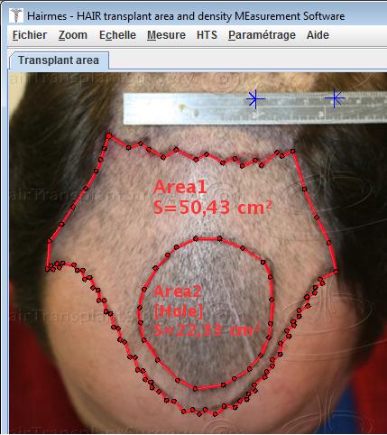Tracing the transplant area contour