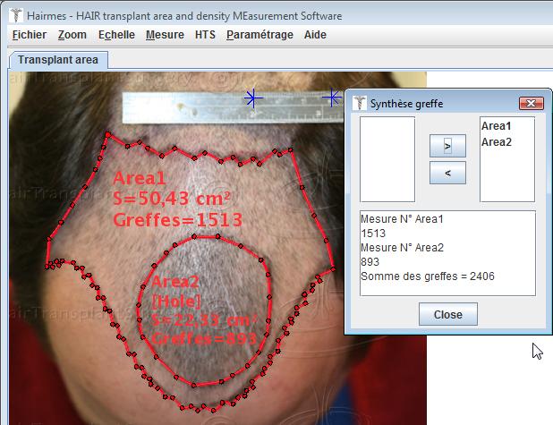 Assigning graft density to transplant areas